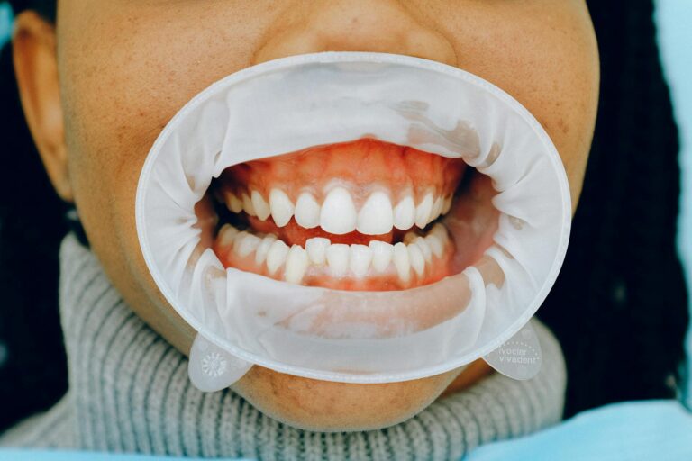 Bruxismo y carillas dentales