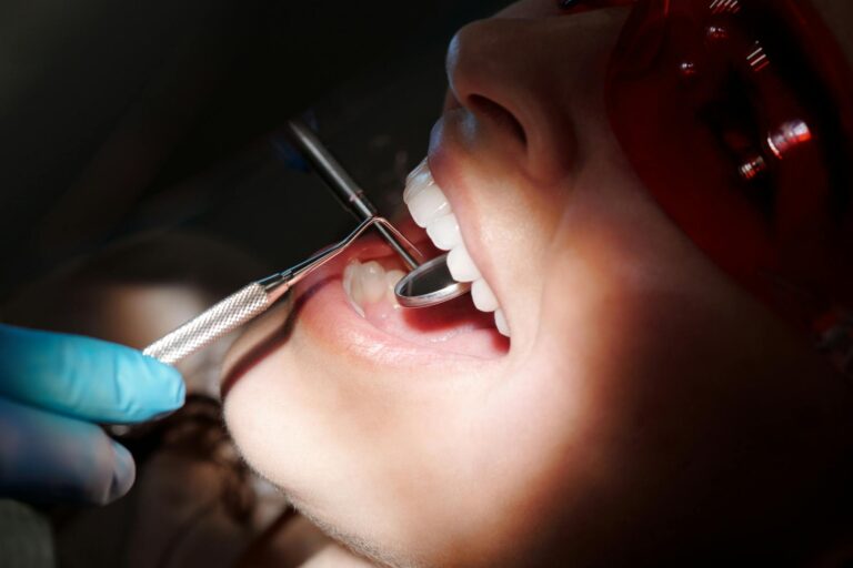 ¿Cuánto dura una carilla dental? Duración y mantenimiento