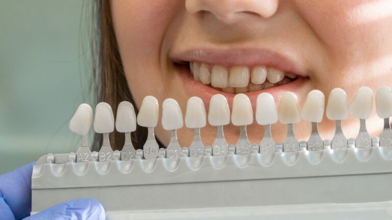 Blanqueamiento dental en Barcelona