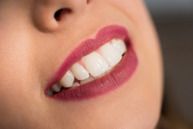 Carillas para dientes pequeños o cortos