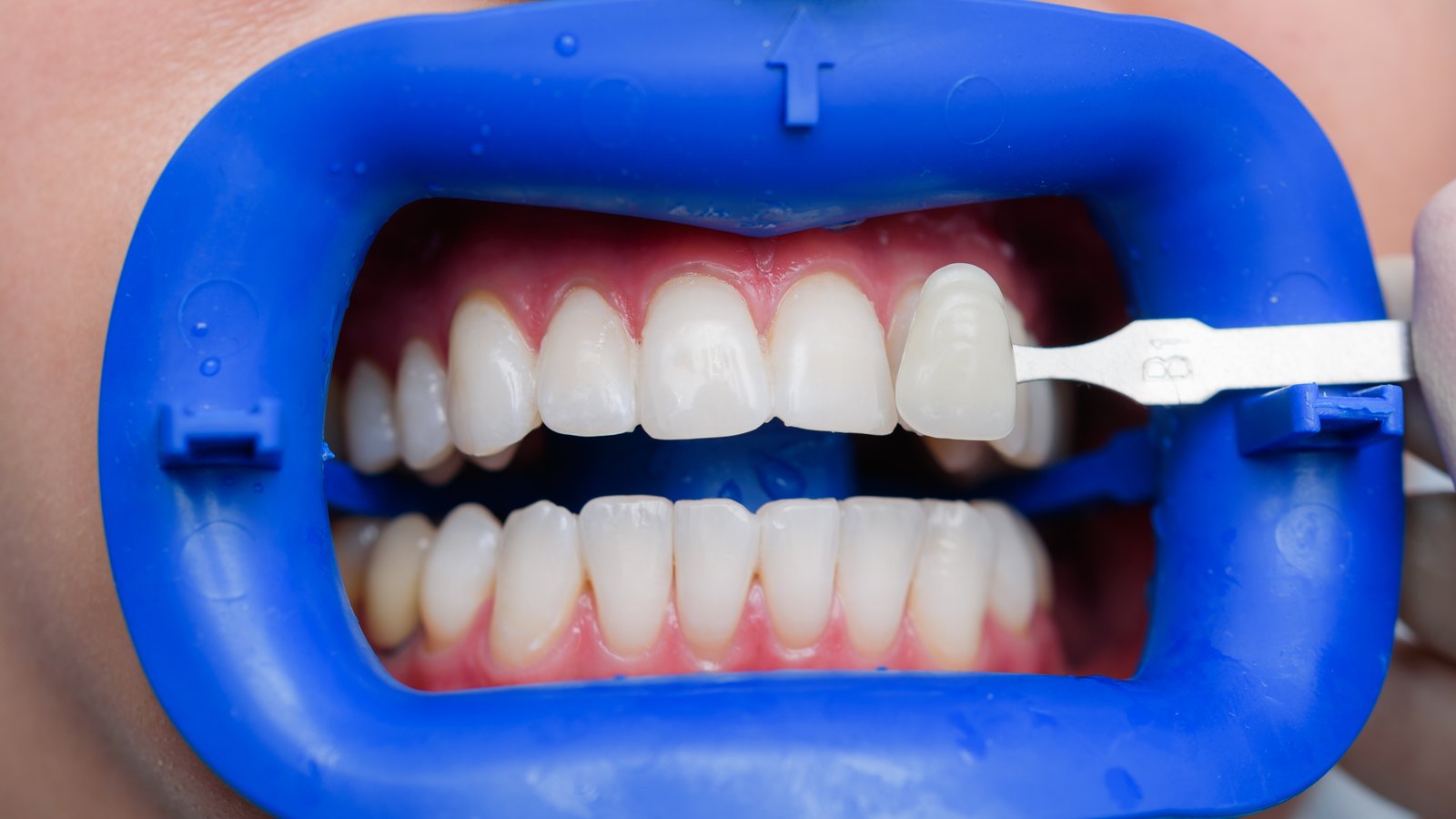 Comparación del tono de los dientes con una muestra de color, con separador labial