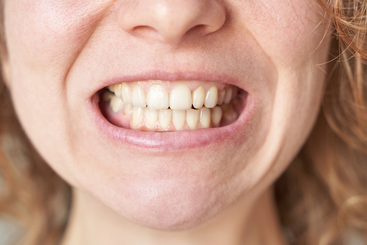 Sonrisa mostrando los dientes de arriba, donde se colocan las carillas