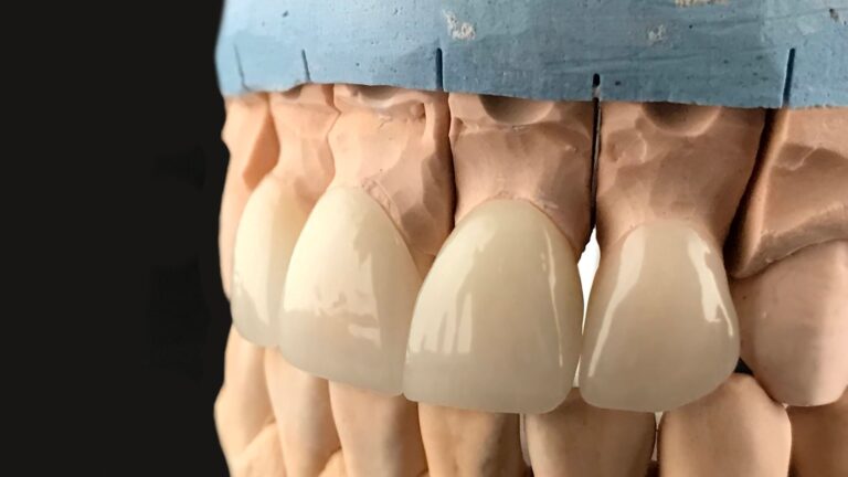 Carillas de composite o porcelana: diferencias y cuál elegir
