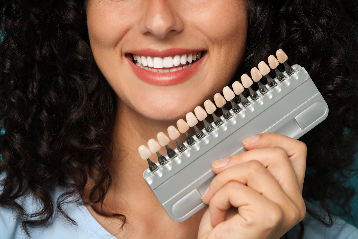 Guía de color del esmalte junto a una sonrisa, para blanquear carillas