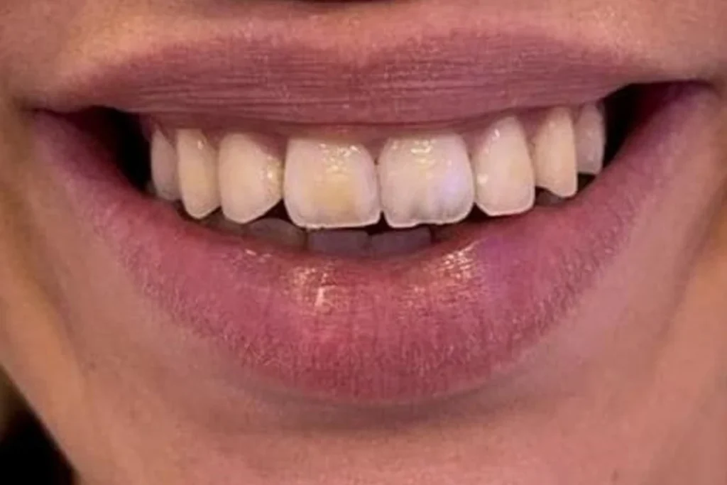 Antes