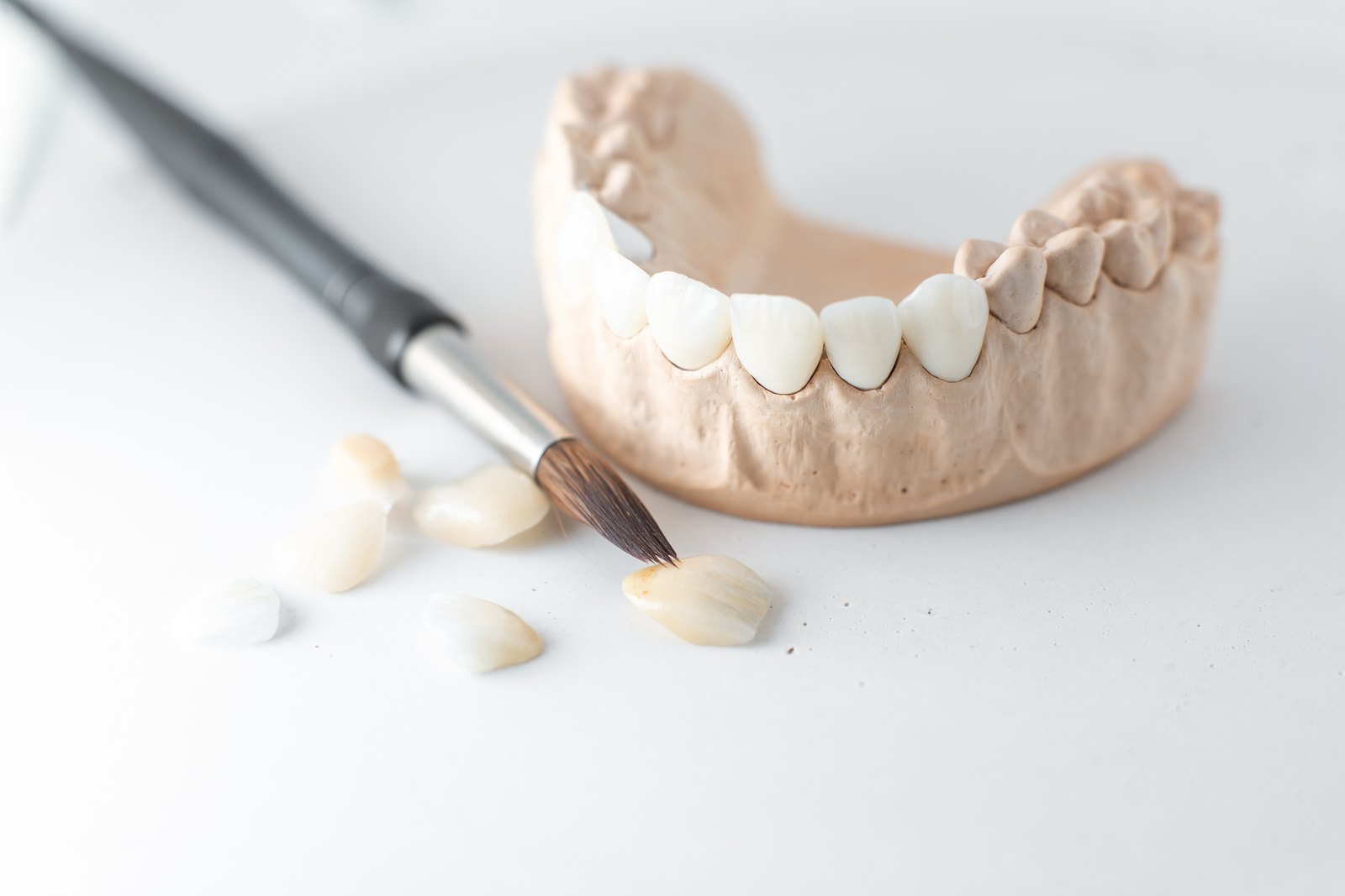 Modelo dental de escayola con carillas en los incisivos, un pincel de ceramista y varias carillas sueltas