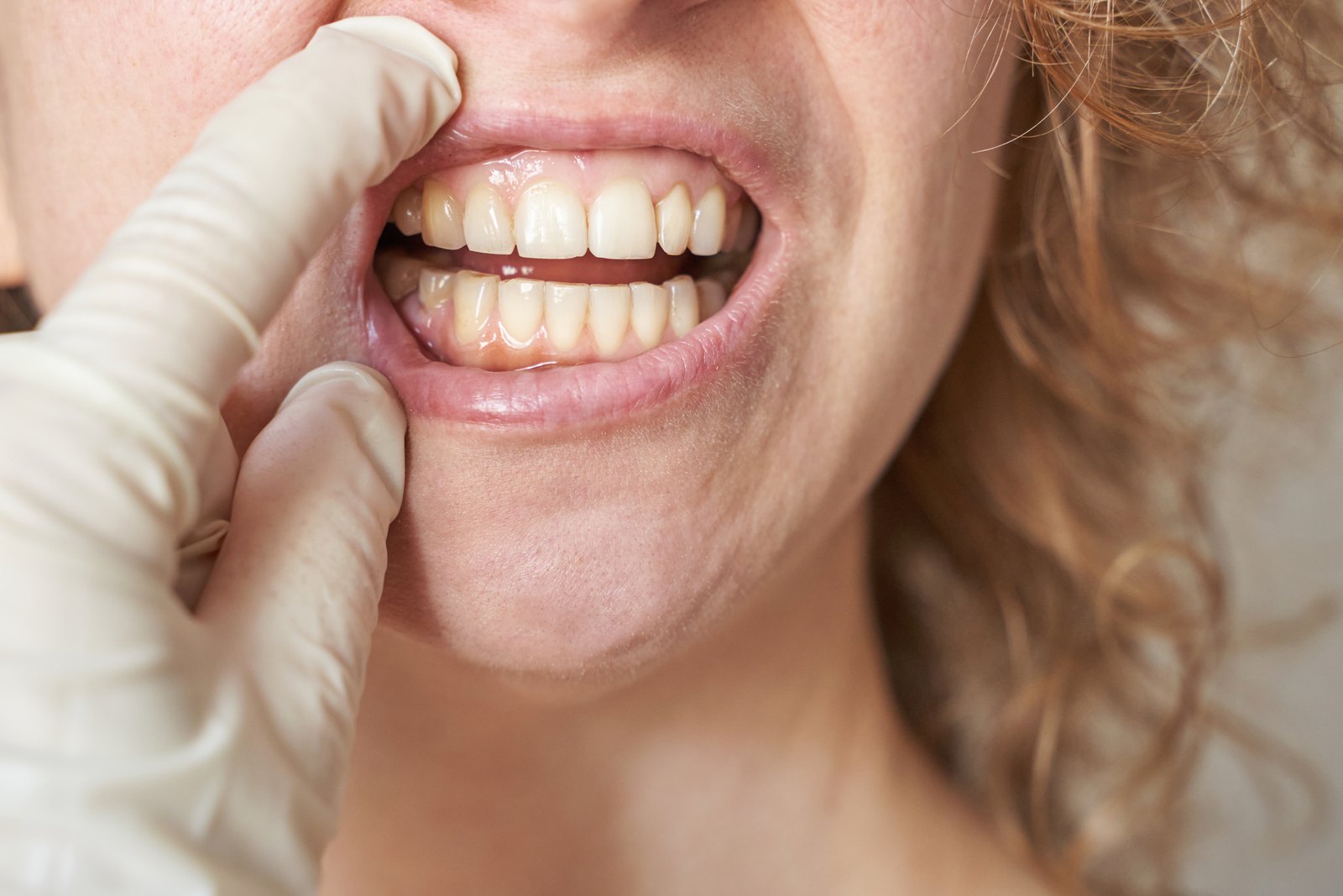Mano con guante levantando el labio superior de una paciente para examinarle los dientes y las encías